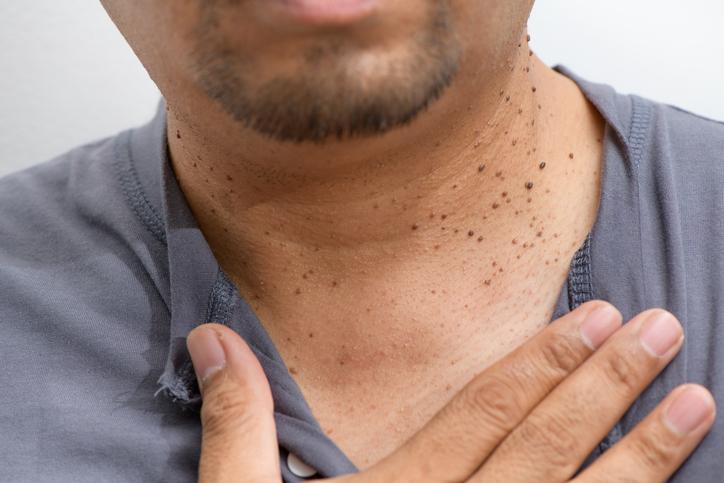 Dermatosis Papulosa Nigra