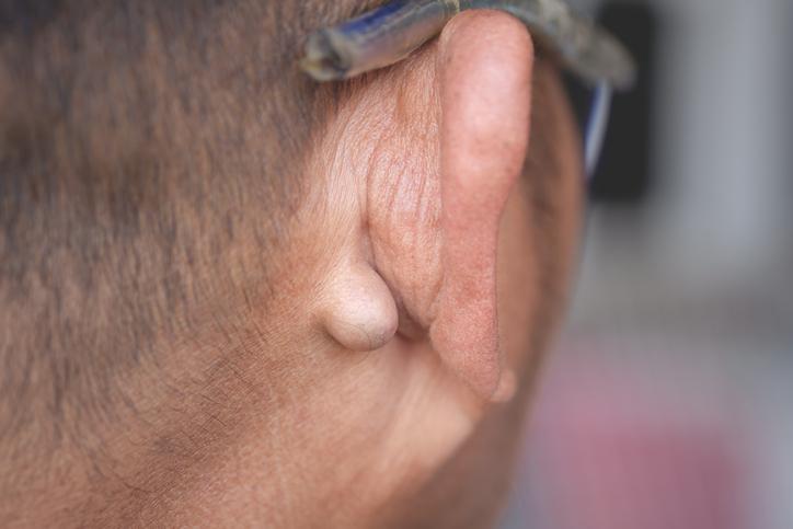 Sebaceous Cysts