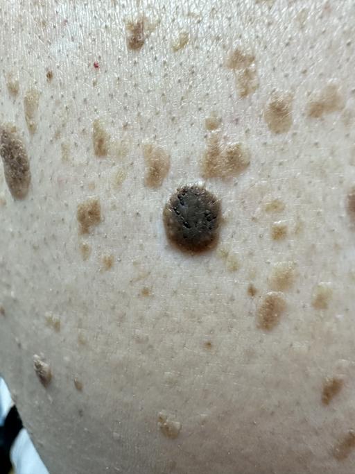Seborrheic Keratosis