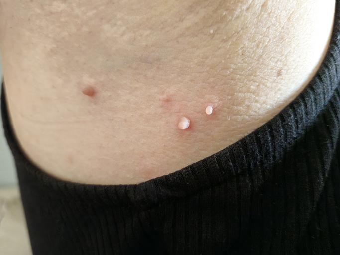 Skin Tags