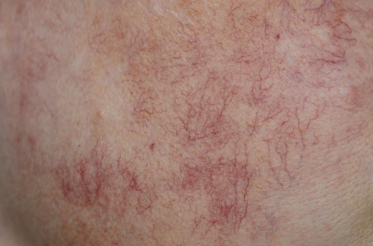 Thread Veins