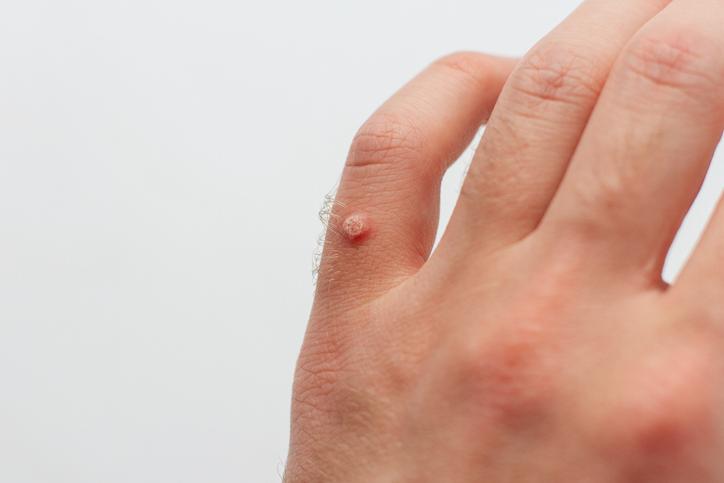 Warts / Verrucas